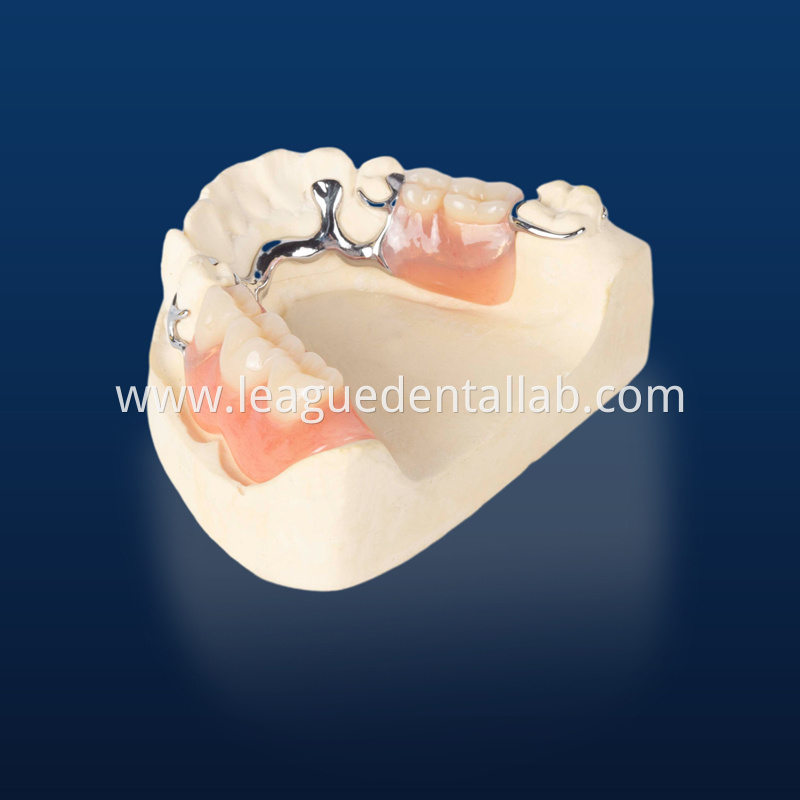 Cast partial,3D printed metal partial,Bego metal partial,cast metal framework,Vatalium Metal framework Cast partial,3D printed metal partial,Bego metal partial,cast metal framework,Vatalium Metal framework